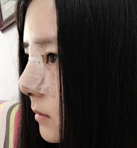到北京做了鼻部手术，已经7个多月了。