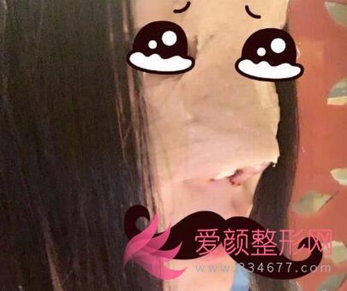 【分享】我在北京做了鼻部手术，圆满了！
