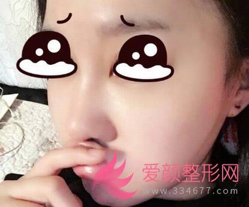【分享】我在北京做了鼻部手术，圆满了！